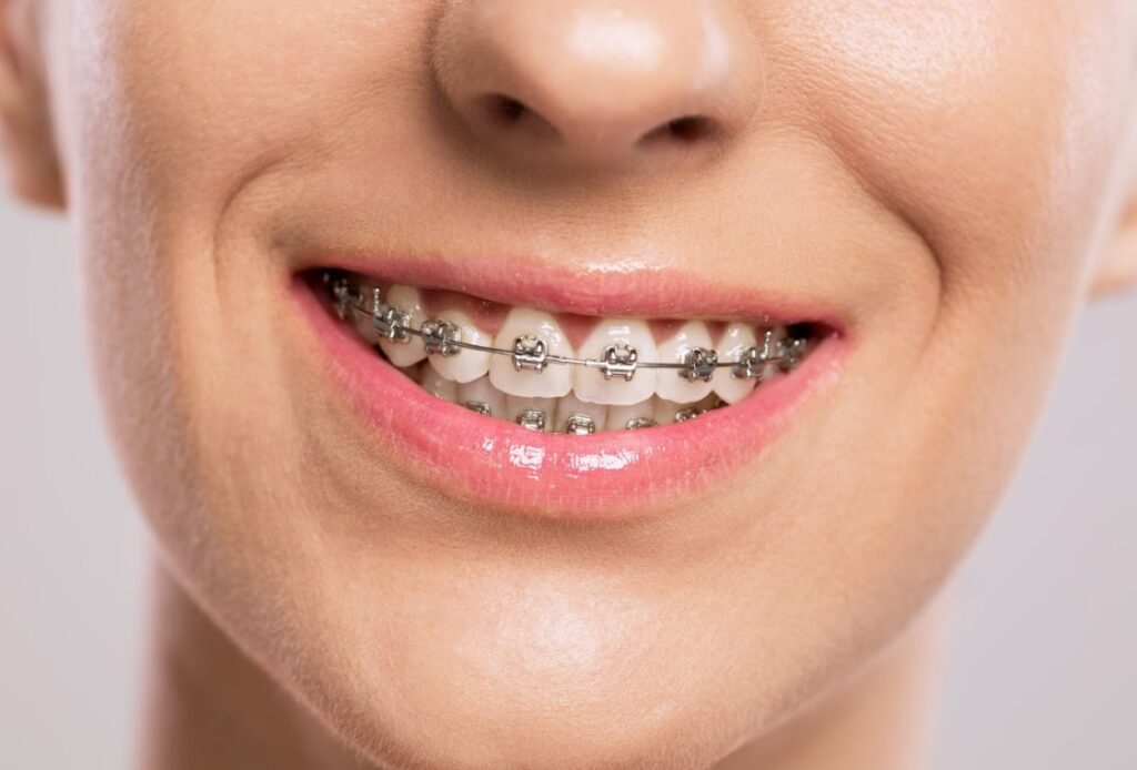 ORTODONCIA CONVENCIONAL Sistema de ortodoncia fija con brackets