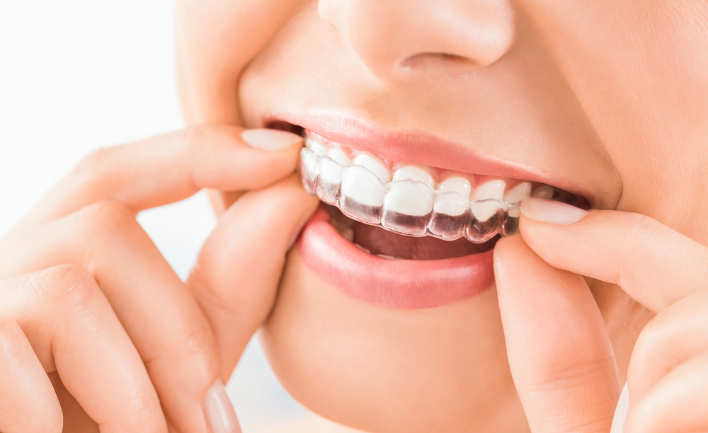 ORTODONCIA INVISIBLE alineadores transparentes para corregir la posición de los dientes