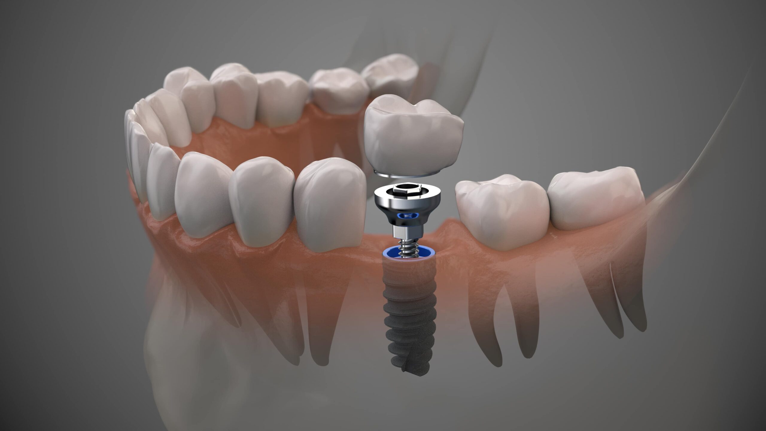 Implante dental