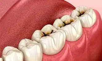 Caries