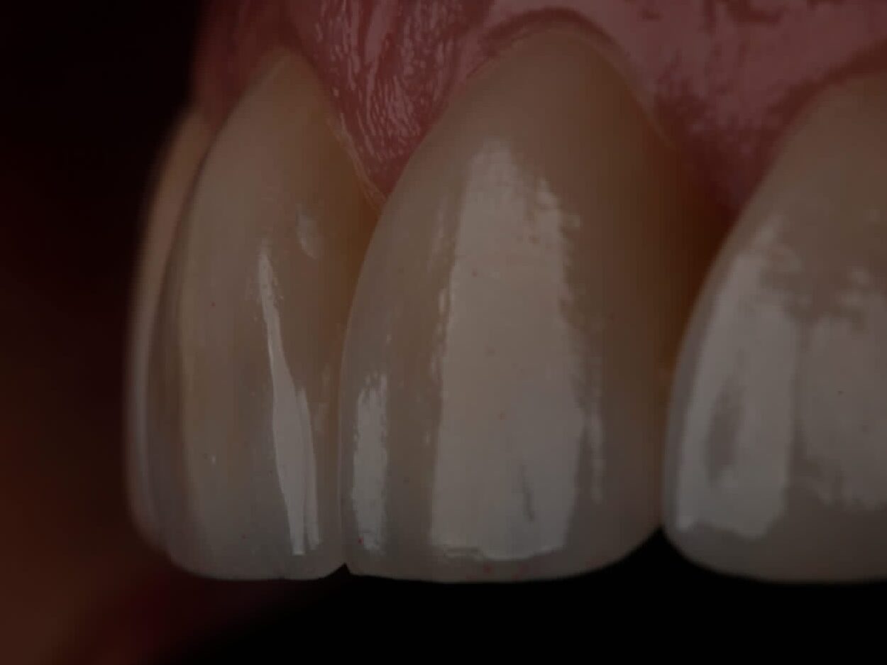 Carillas-Dentales-Naturales-Clinica-Cde.jpg.