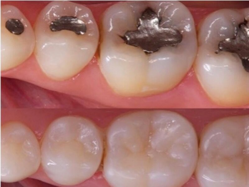 Antes y después de cambiar amalgamas dentales por resinas estéticas en CDE Clínica Dental Especializada.