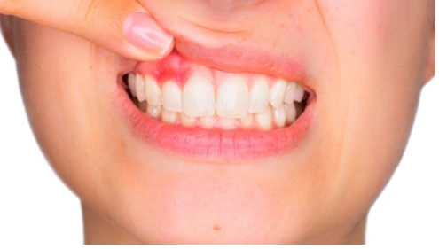 Paciente mostrando sangrado de encías durante el embarazo asociado a inflamación gingival, signo frecuente de gingivitis gestacional.