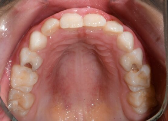 Caries en niños visibles en los dientes temporales
