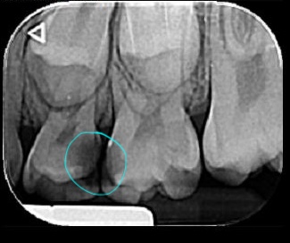 Dolor de muela en niños asociado a caries observadas en radiografía periapical