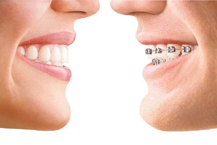 Comparación de ortodoncia en Palmira entre una sonrisa sin brackets visibles y otra con brackets metálicos.